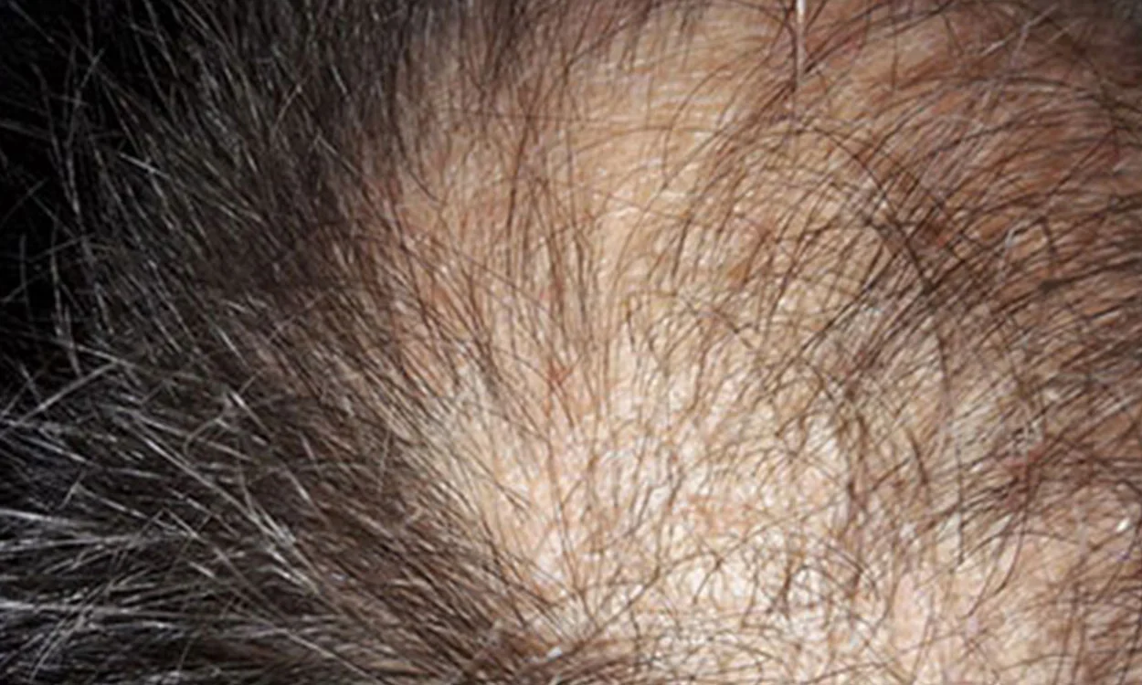 La pérdida de cabello durante la menopausia